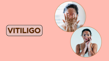 Vitiligo Treatment
